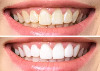 Diş Beyazlatma Öncesi Sonrası Fotoğraf Nasıl Çekilir?